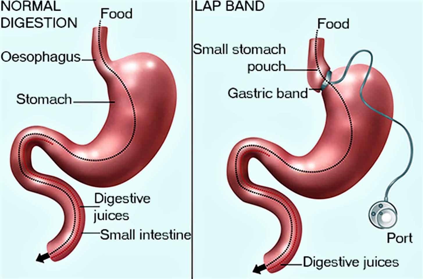 Why is Gastric Band No More Preferred? Look at the Alternatives