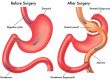 How to know when you need a Gastric bypass surgery revision