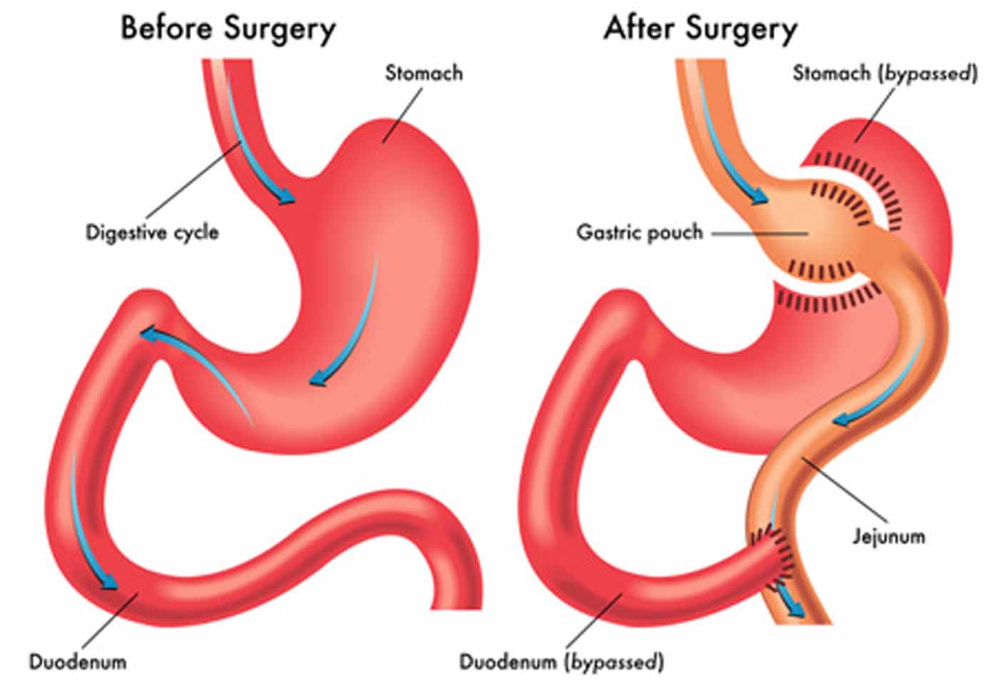 How to know when you need a Gastric bypass surgery revision Better